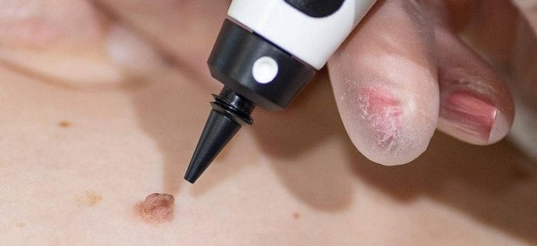 After Skin Tag Removal Small Heath