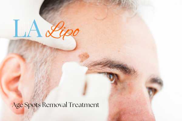 What Are the Most Effective Treatments for Age Spots Small Heath?