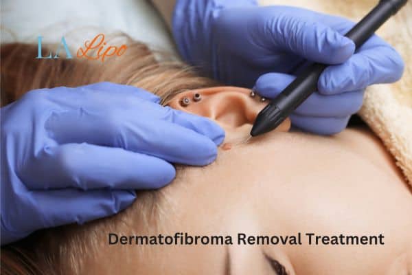 Dermatofibroma Removal Treatment Small Heath