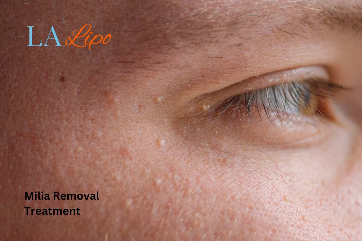 Cryopen Milia Removal: Is It the Easiest and Safest Option Small Heath?