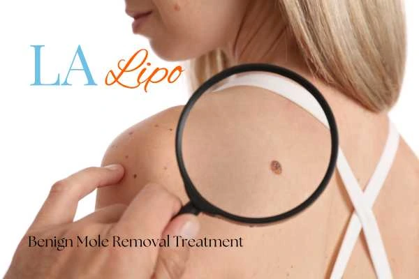 Woman having her inspection of blemish before mole removal Small Heath