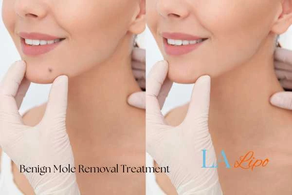 Before and after mole removal Small Heath treatment