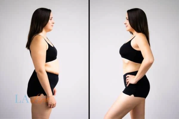image of woman before and after results of LA-EMS Body Sculpting Small Heath to help treat Diastasis recti