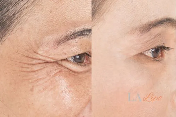 Before and after results of woman - HI-fu wrinkles reduction treatment Small Heath