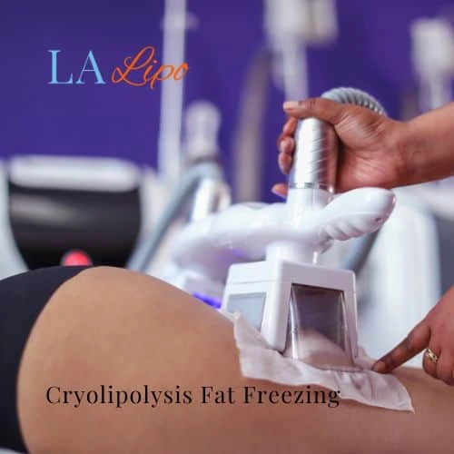 fat freezing - Cryolipolysis Small Heath