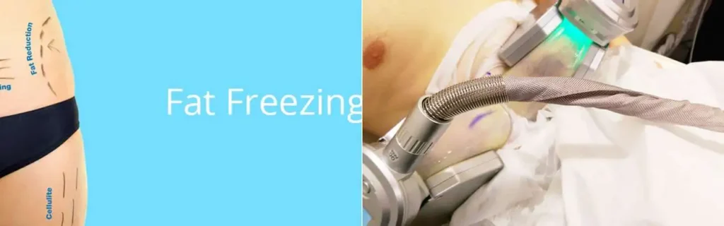 Fat freezing Small Heath on multiple areas of the body