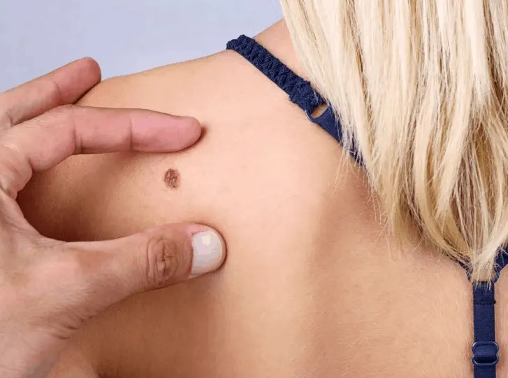 woman having mole removal Small Heath consultation before treatment.