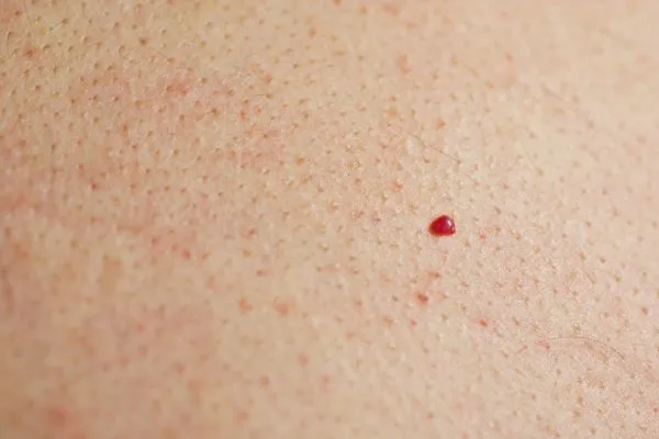 close up of a cherry angioma Small Heath