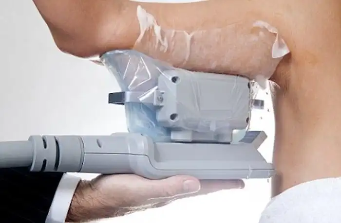 Picture of fat freezing Small Heath on the upper arms.