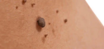 image of a skin tag Small Heath