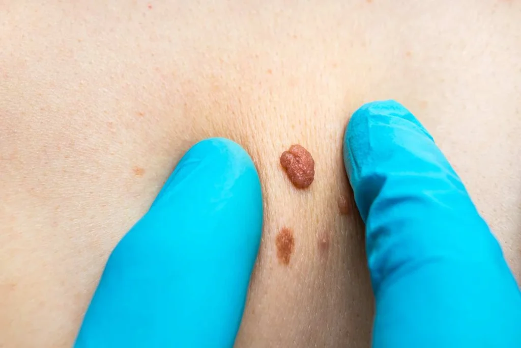 Consultant examining a skin tag Small Heath