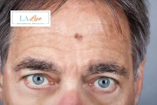 Solar Lentigo Removal Small Heath image of man with mark on his forehead