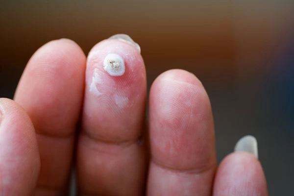 wart on person finger - cryotherapy to treat from LA LIPO Small Heath