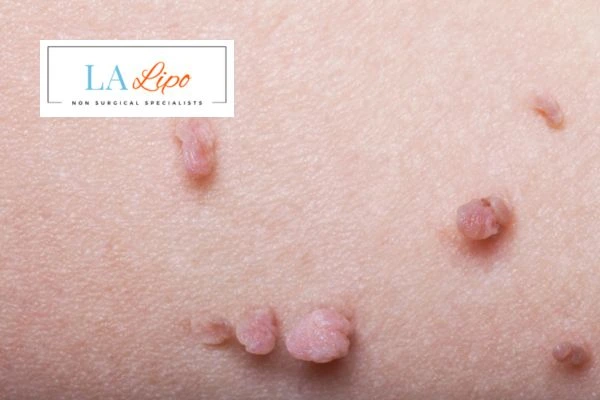 Does cryopen skin tag removal Small Heath hurt? Find out now call our team today!