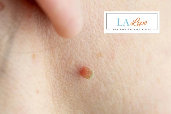 Book skin tag removal Small Heath today speak to our team now!