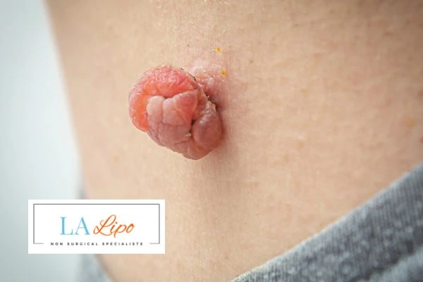 Interested in skin tag removal Small Heath? Concerned about the pain? Find out more today!