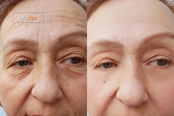 The powerful benefits of Morpheus8 Treatment Small Heath - Call Our team today!