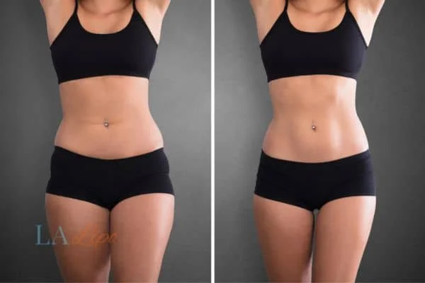 before and after results of non-surgical treatment to help a woman's body image and mental health Small Heath