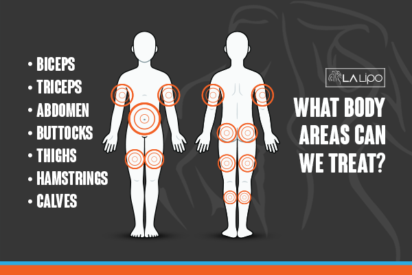 Diagram to show areas you can have LA-EMS Body Sculpting Treatment Small Heath