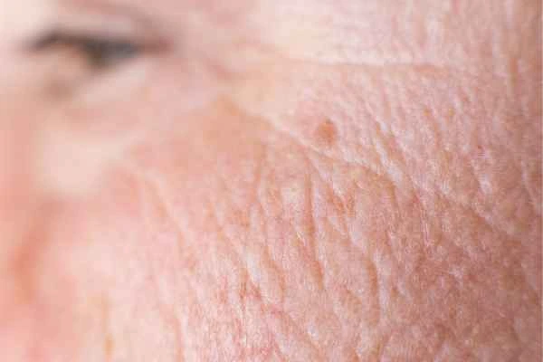 close up picture of a woman's face showing an age spot Small Heath