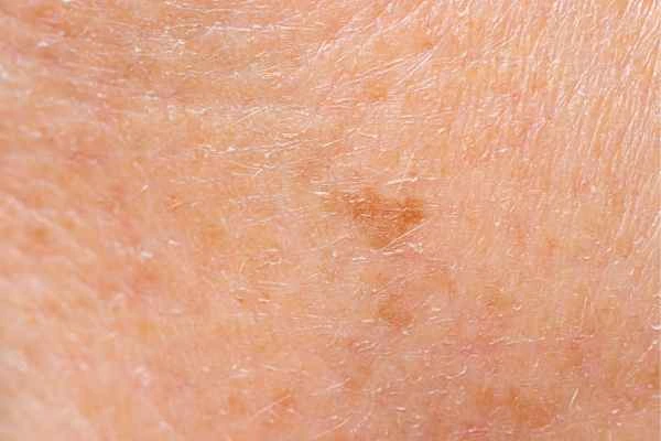 close up picture of age spots Small Heath