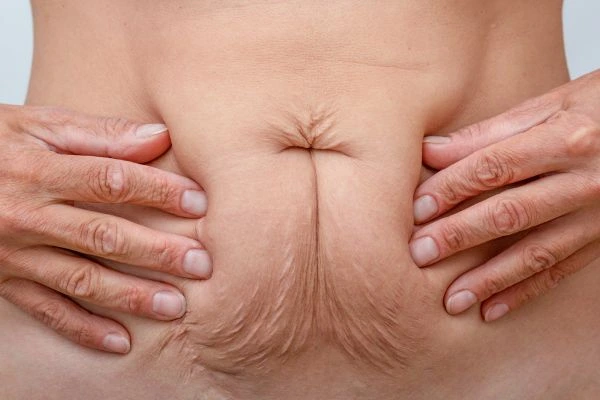 Image of a woman's stomach with loose skin - example of skin tightening Small Heath options